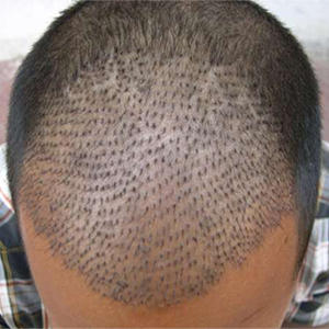 Hair Transplant Cost in Qatar, Low Cost Hair Transplant Specialist Doctors  Clinic in Qatar