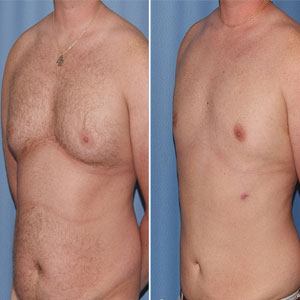 Male Chest Reduction Surgery Clinics in Uganda Male Chest